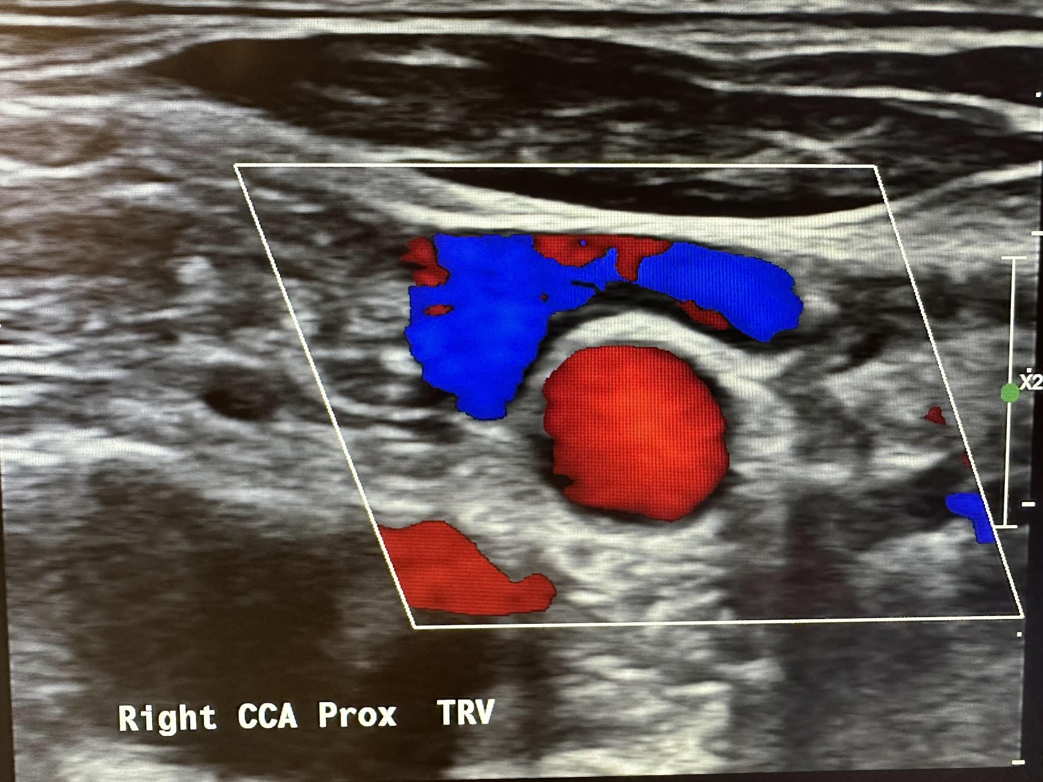 Right common carotid artery in the proximal transverse plane with the jugular vein on top, demonstrating blood flow in opposite directions.