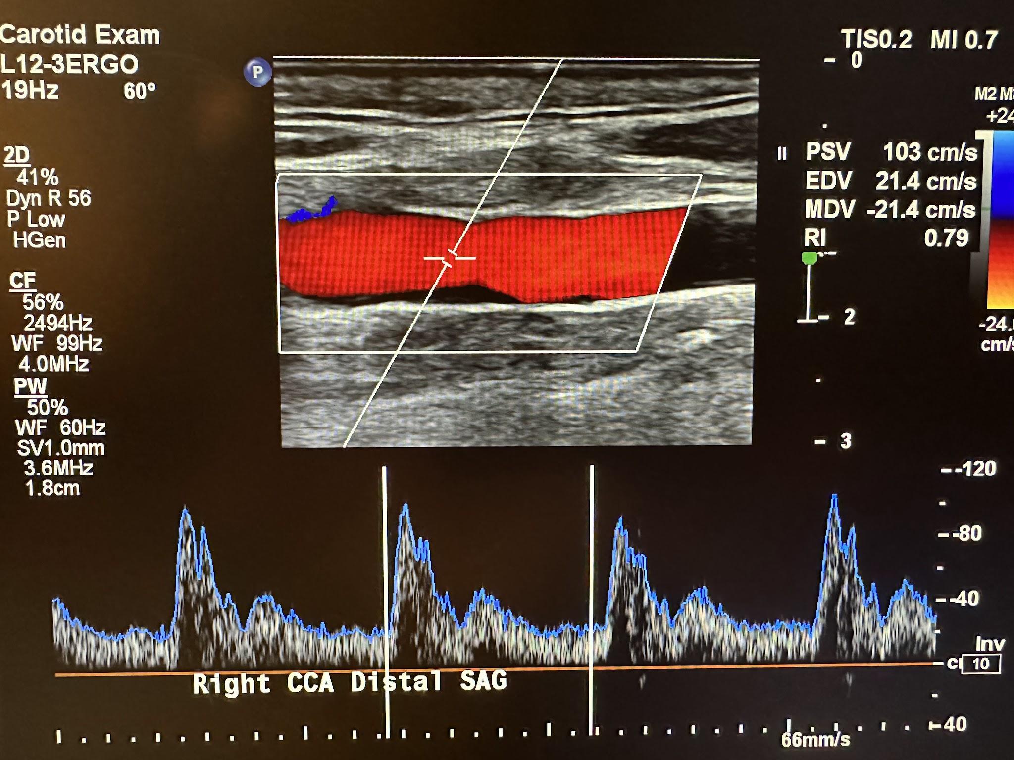 Pulsed wave Doppler with spectral analysis of the common carotid artery in the distal sagittal plane.