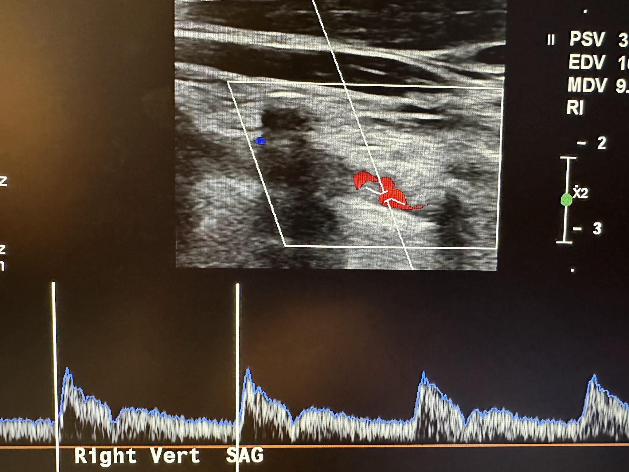 Sagittal view of the right vertebral artery with color flow.