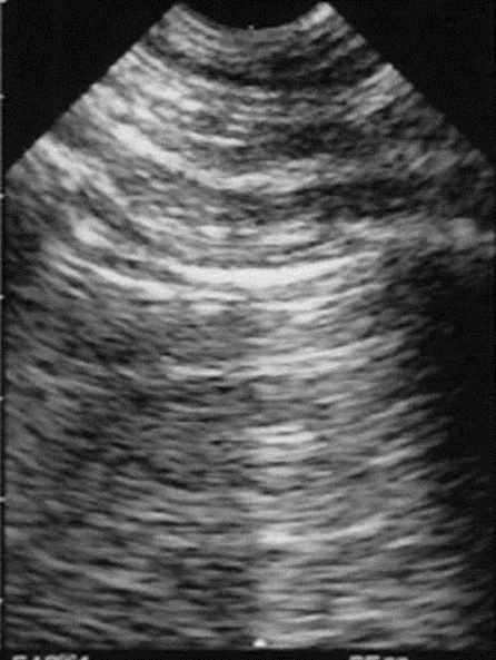 Pleural line with A-lines similar to Figure 8-1, indicating gas below the pleural line.