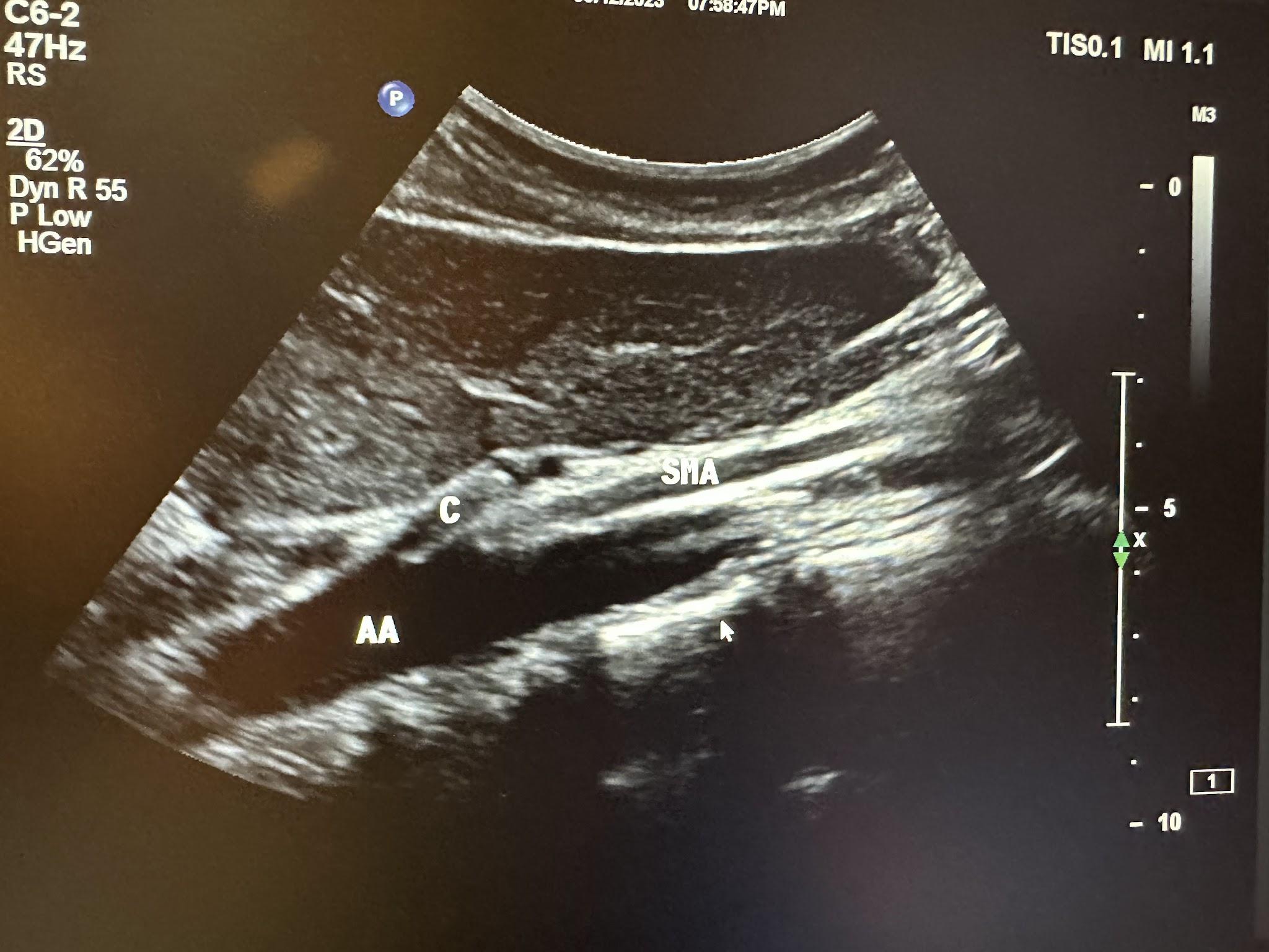 Sagittal image of proximal aorta without Doppler showing the abdominal aorta, celiac artery, and superior mesenteric artery.