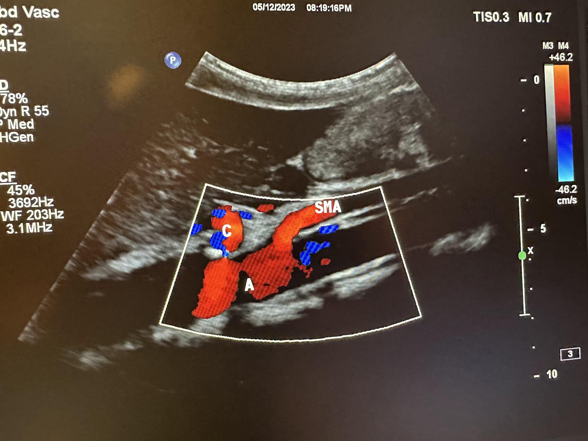 Sagittal image with color Doppler showing the abdominal aorta, celiac artery, and superior mesenteric artery.