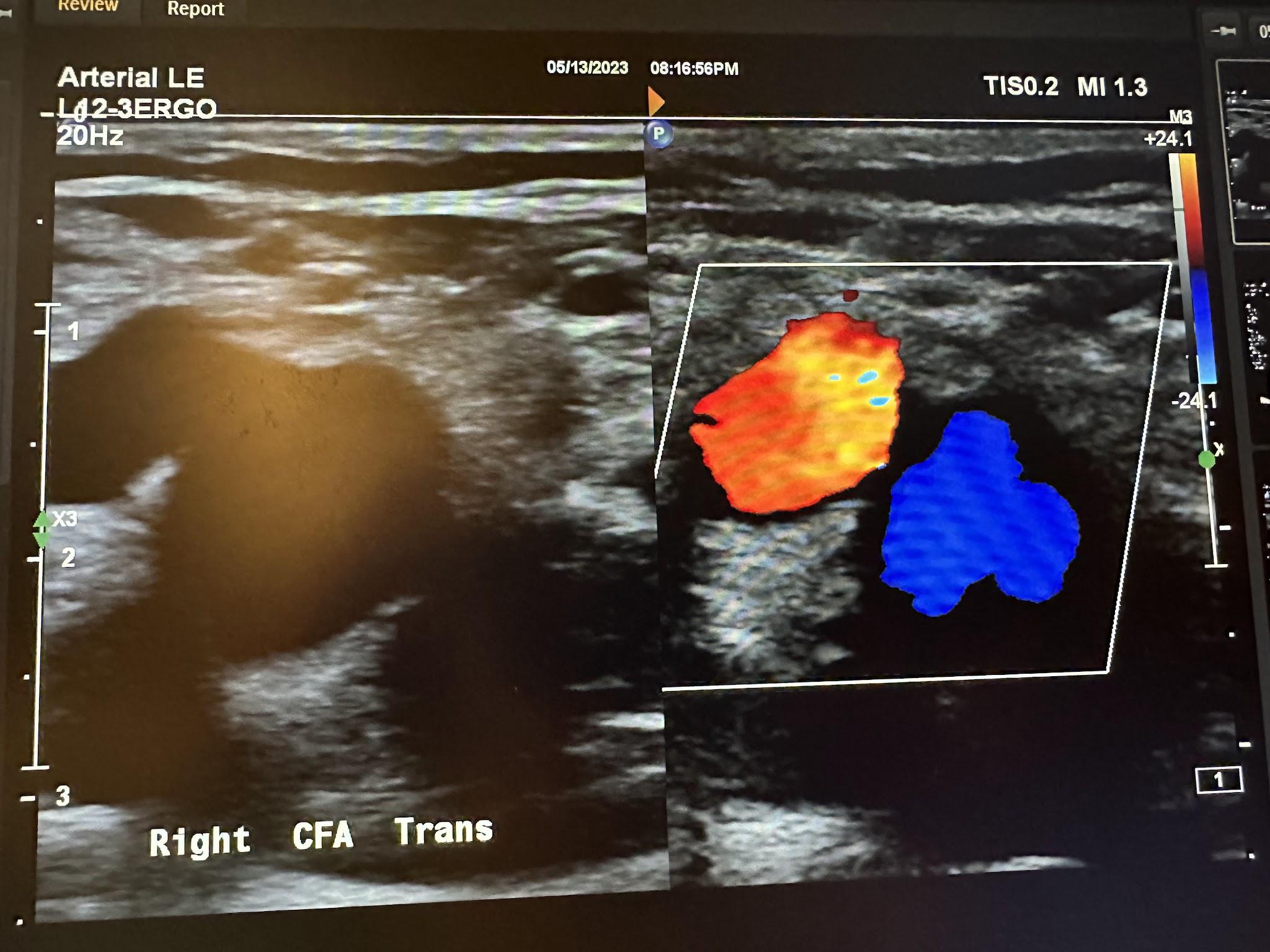 Side-by-side transverse images of the right common femoral artery without color Doppler and with color Doppler.