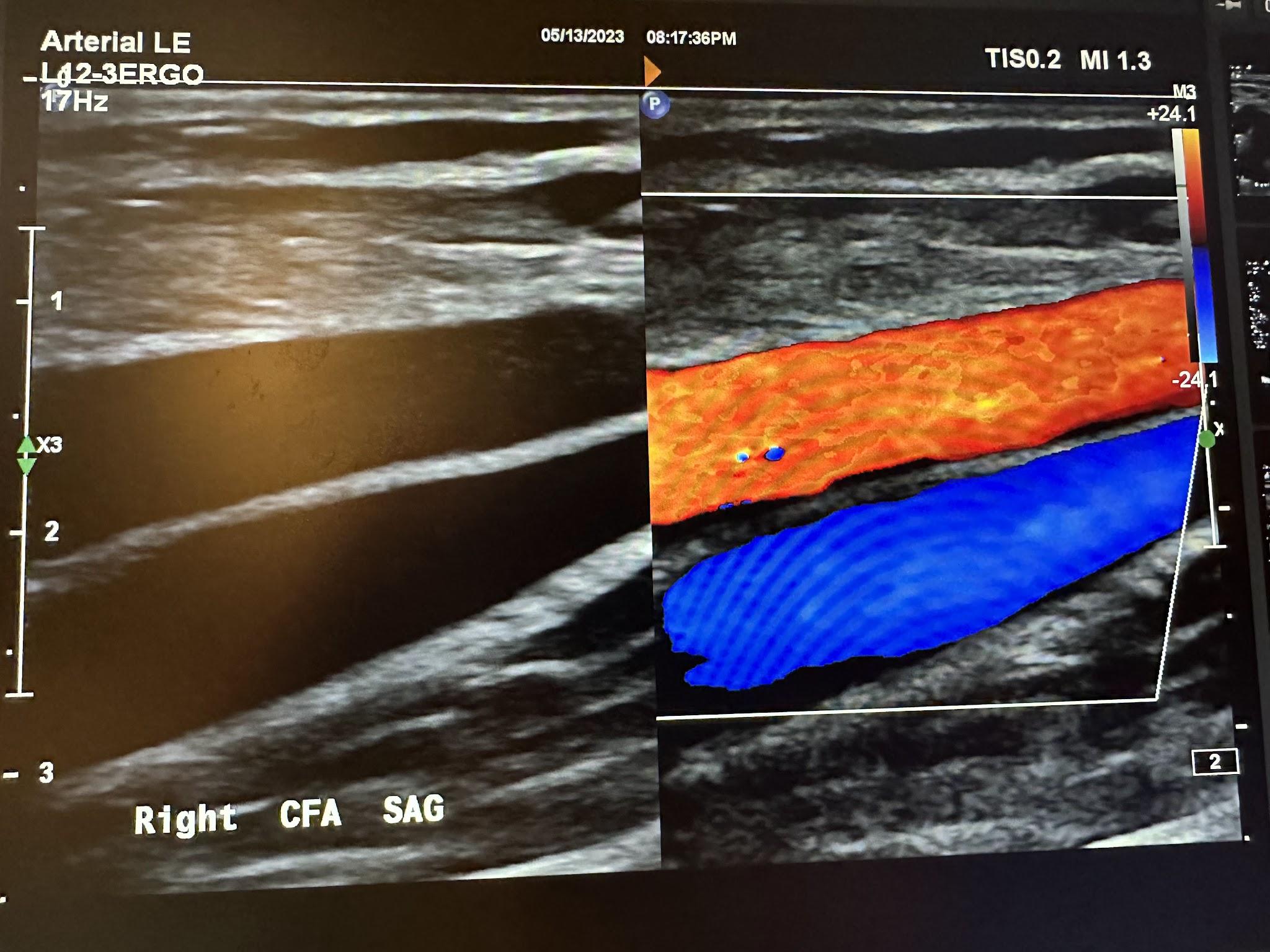 Side-by-side sagittal images of the right common femoral artery without color Doppler and with color Doppler.