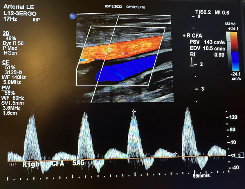 Sagittal image of the right common femoral artery with color Doppler and waveform analysis.