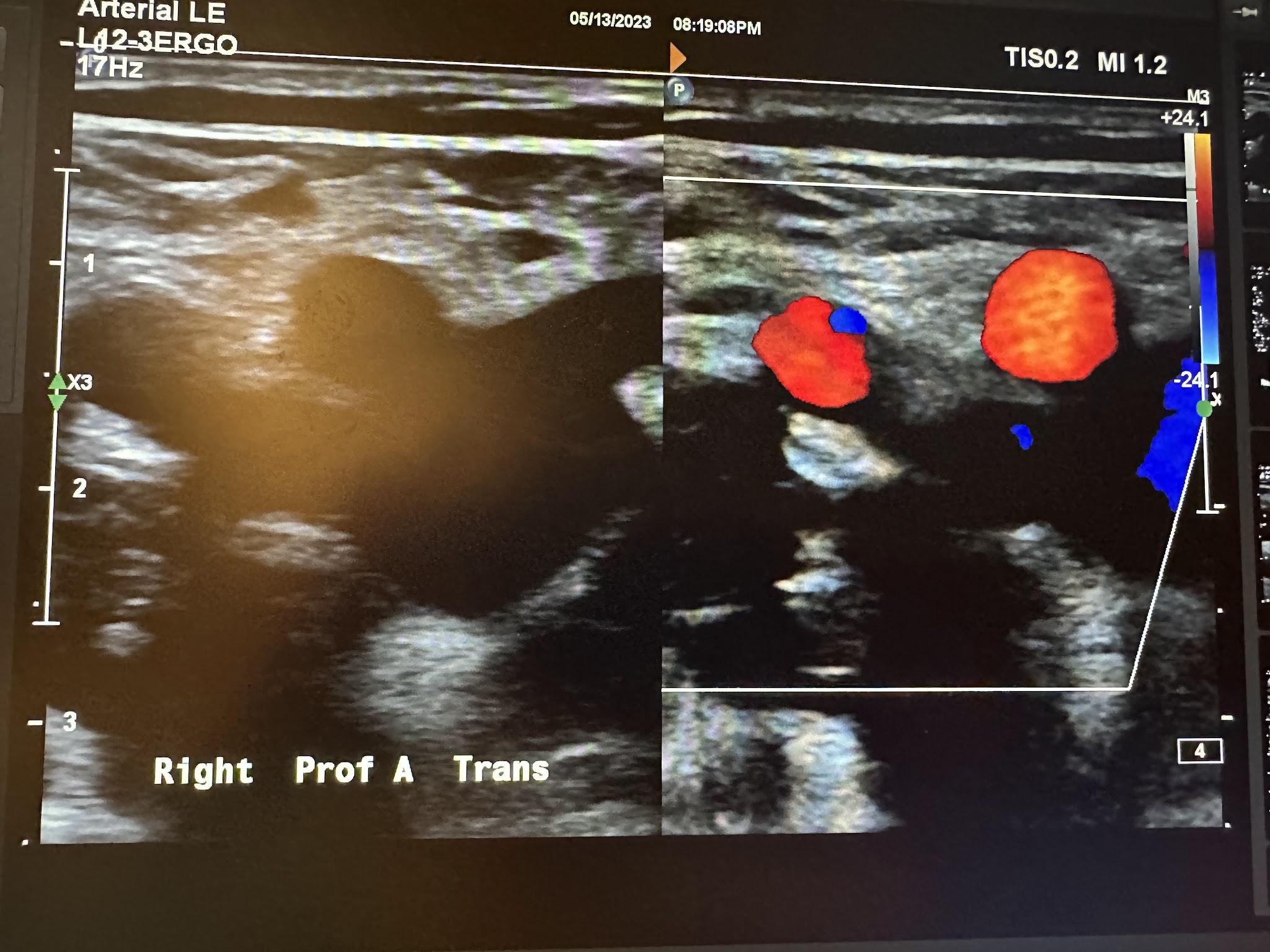 Side-by-side transverse images of the right profunda femoral artery without color Doppler and with color Doppler.