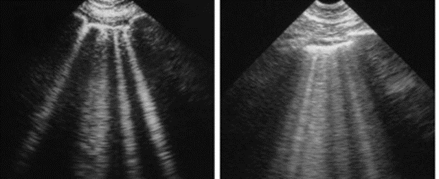 The image on the left shows four or five B-lines. The image on the right shows twice as many B-lines with two examples of pulmonary edema.