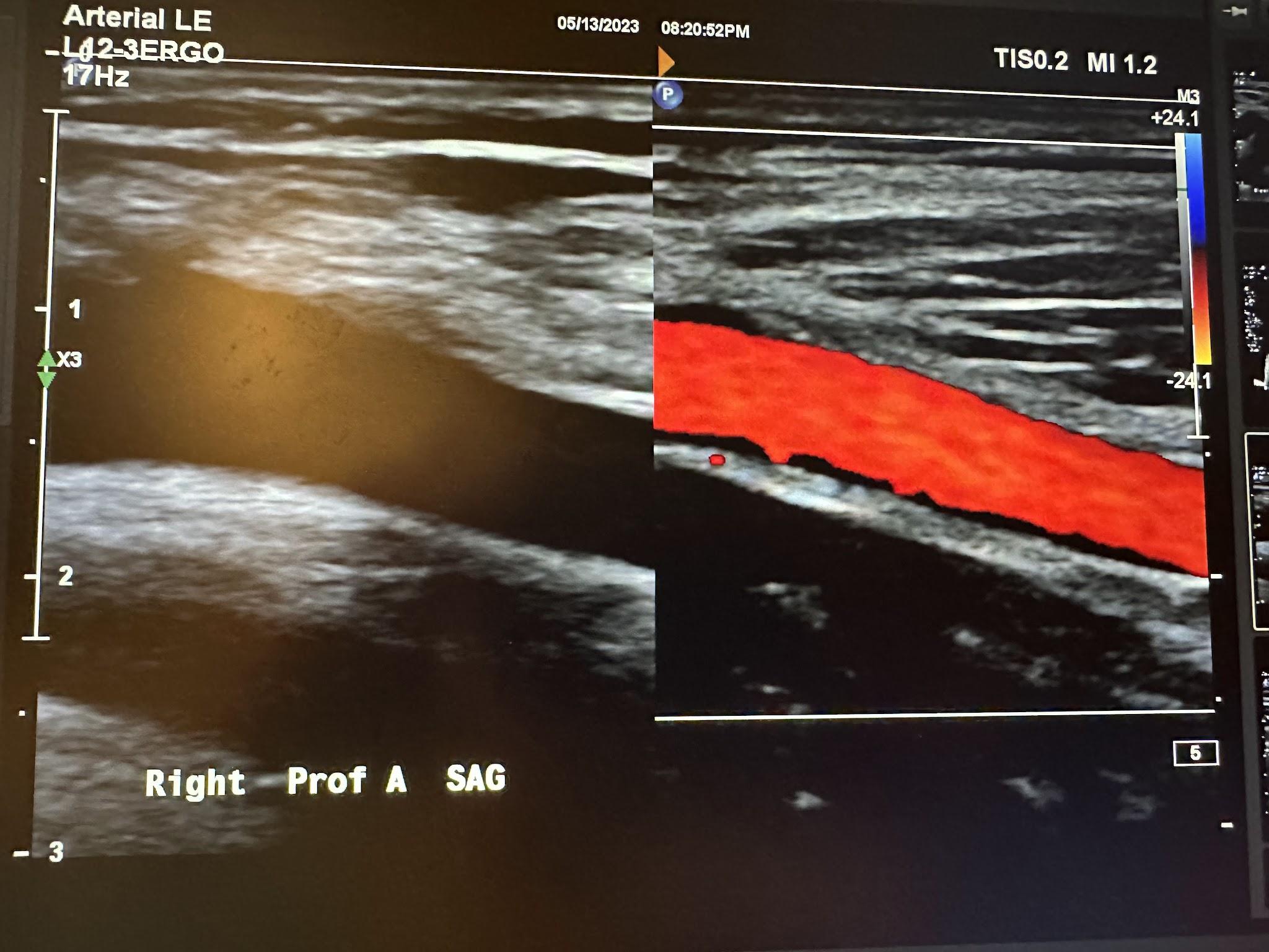 Side-by-side sagittal images of the right profunda femoral artery without color Doppler and with color Doppler.