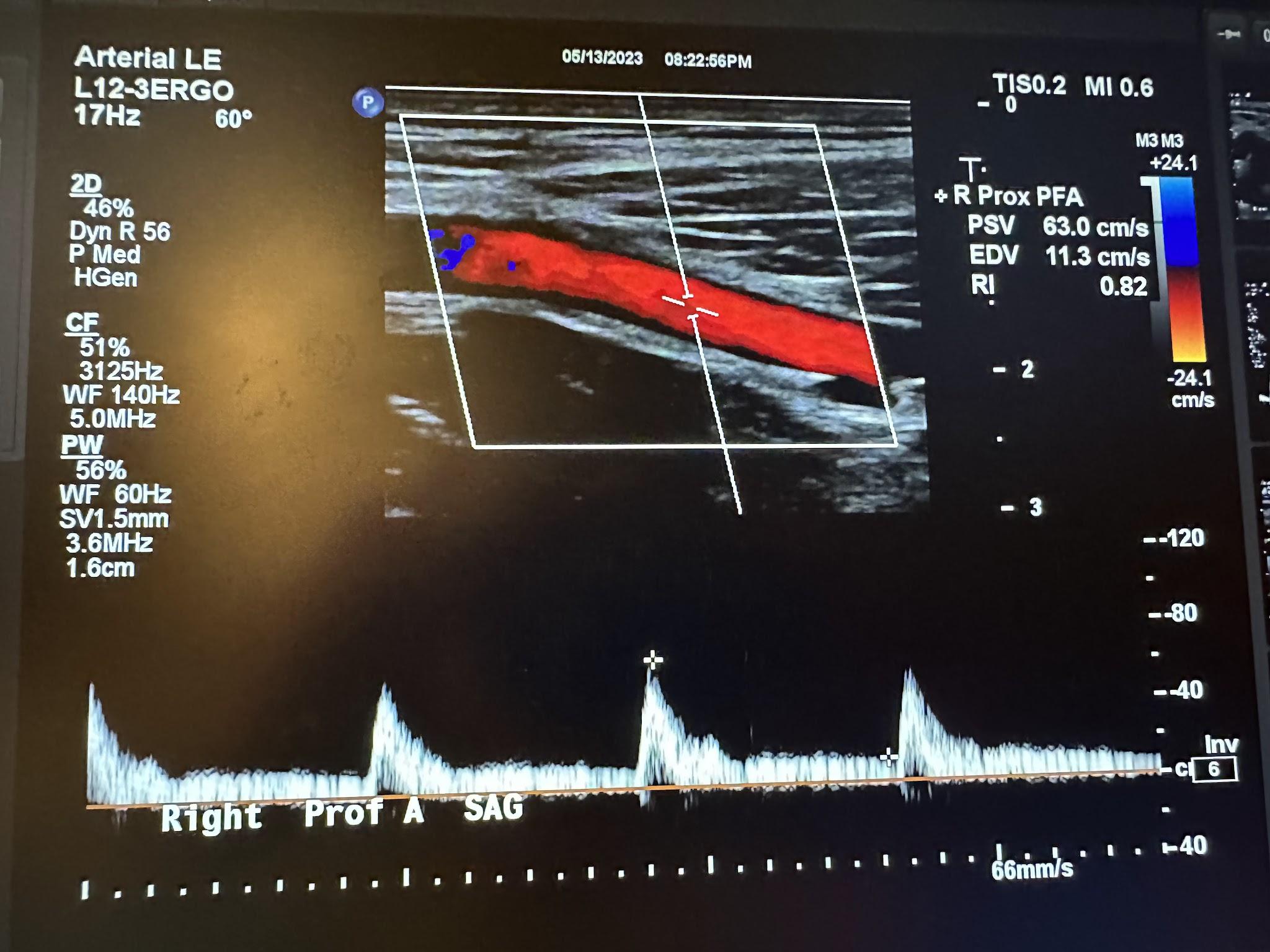 Sagittal image of the right profunda femoral artery with color Doppler and waveform analysis.