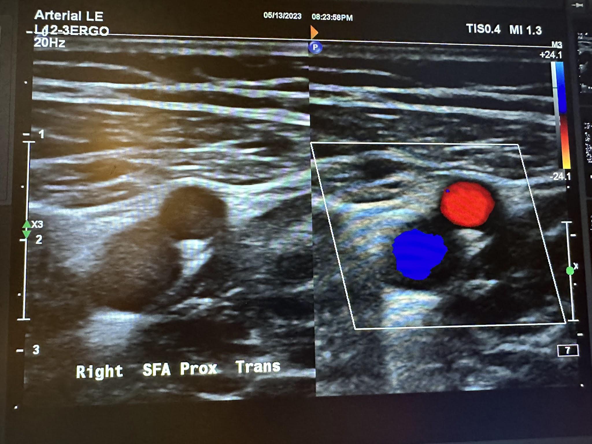 Side-by-side transverse images of the right proximal superficial femoral artery without color Doppler and with color Doppler.