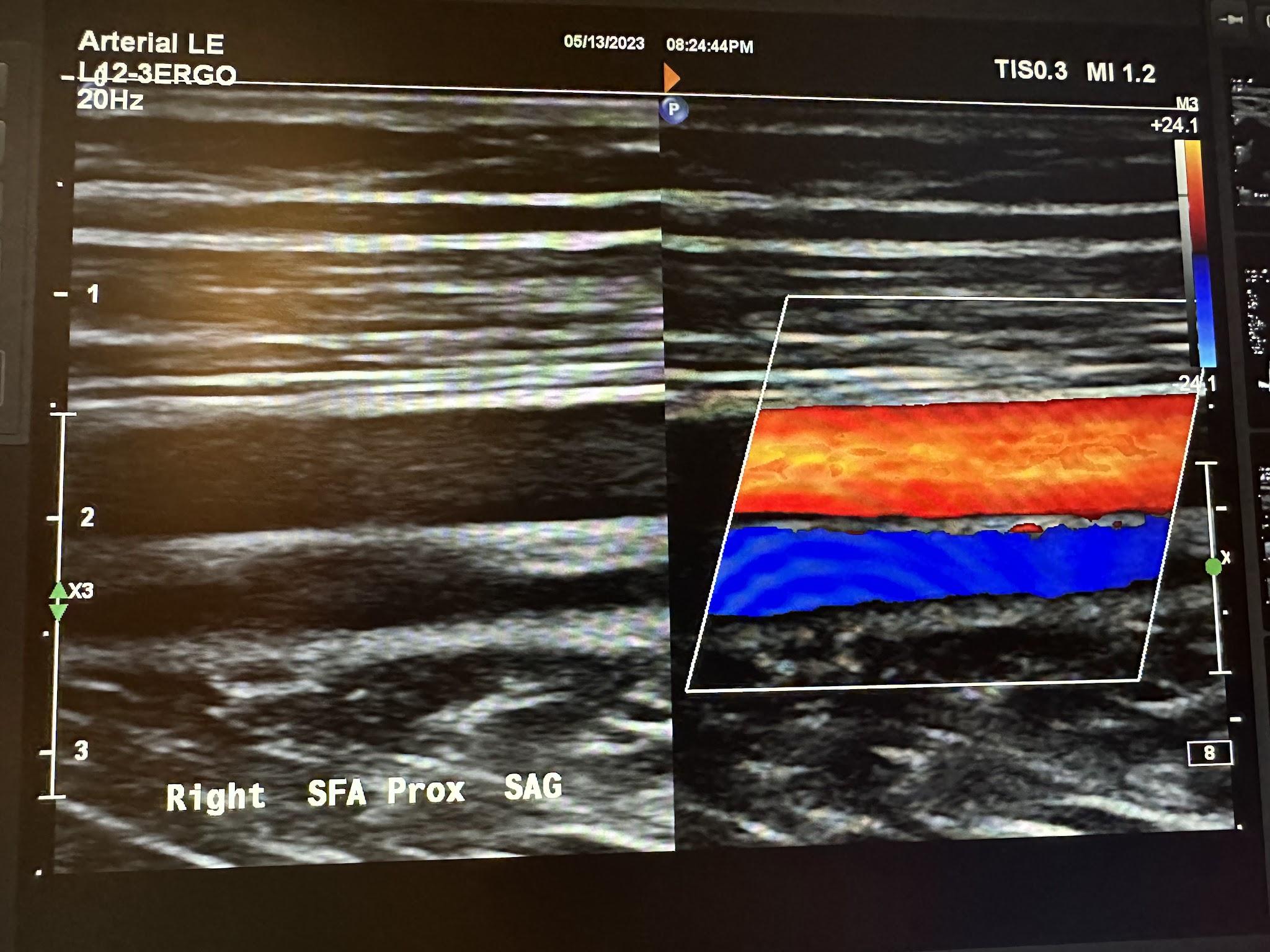 Side-by-side sagittal images of the right proximal superficial femoral artery without color Doppler and with color Doppler.