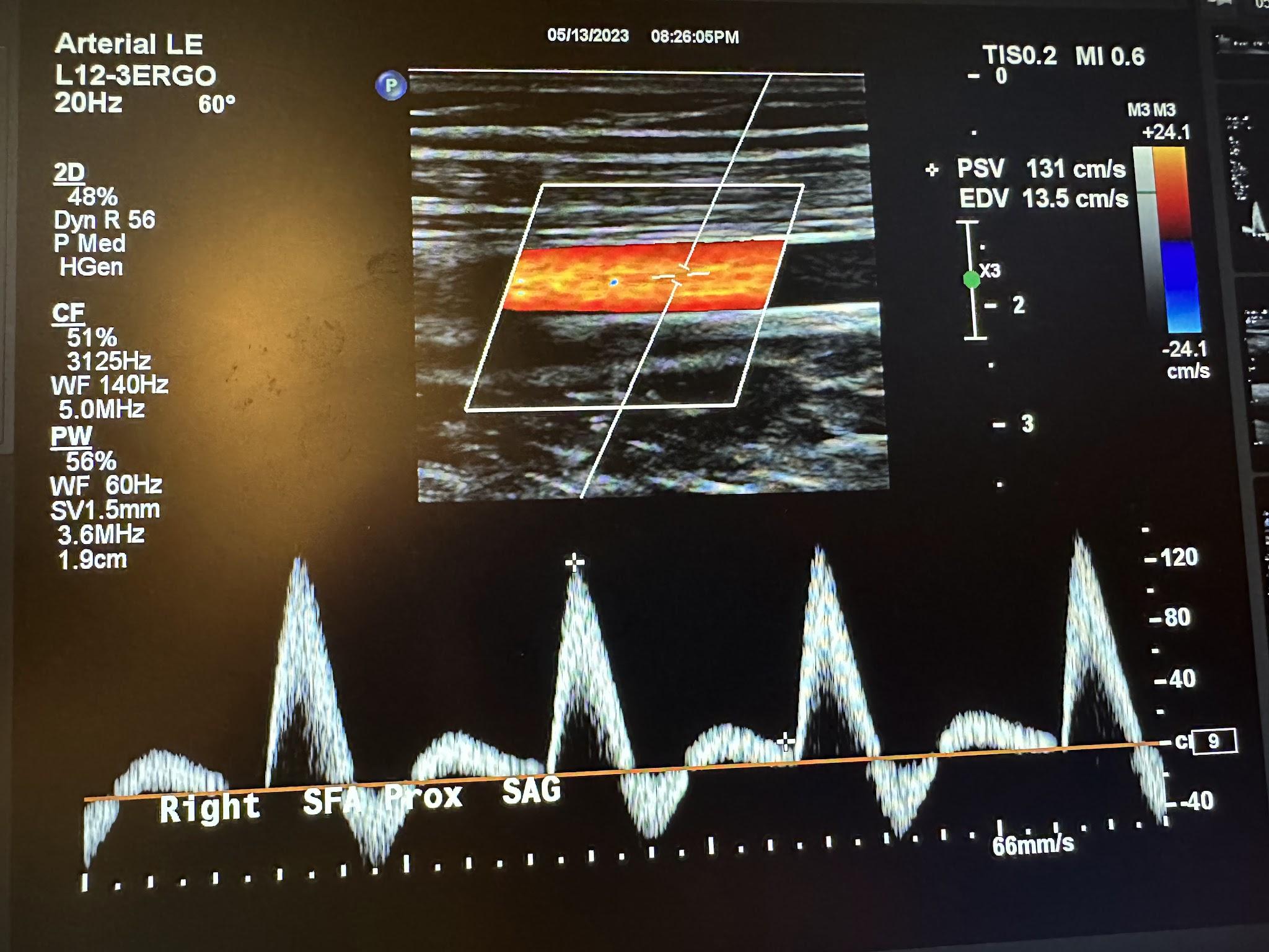 Sagittal image of the right proximal superficial femoral artery with color Doppler and waveform analysis.