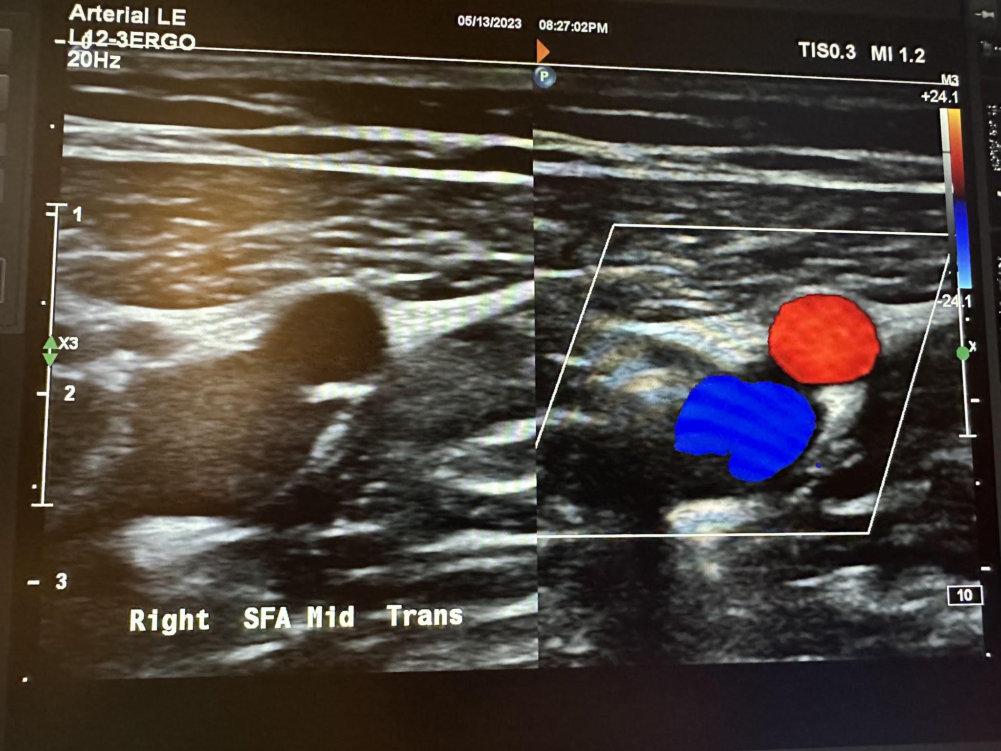 Side-by-side transverse images of the right middle superficial femoral artery without color Doppler and with color Doppler.