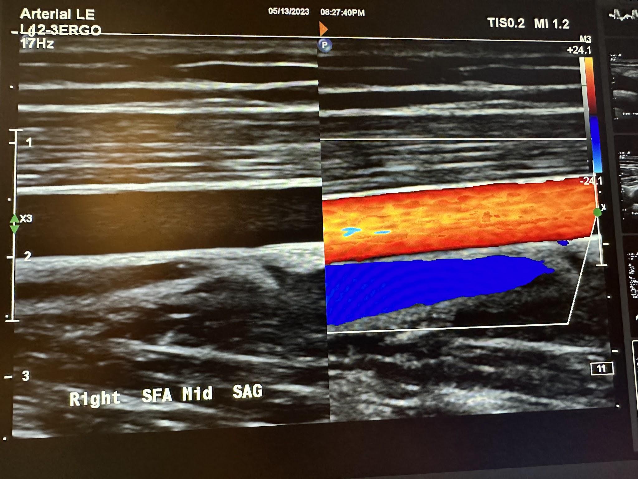 Sagittal image of the right middle superficial femoral artery without color Doppler and with color Doppler.