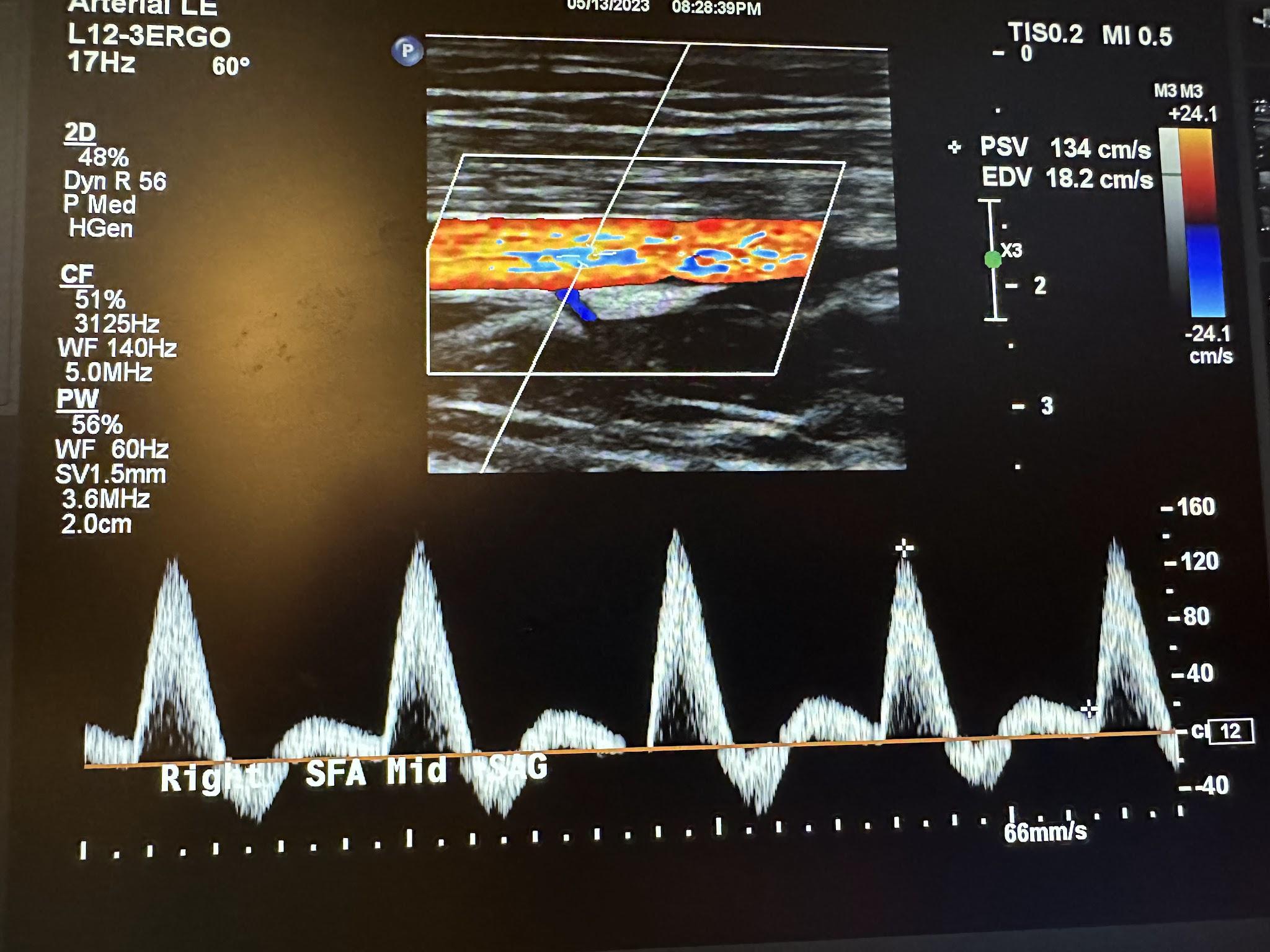 Sagittal image of the right middle superficial femoral artery with color Doppler and waveform analysis.