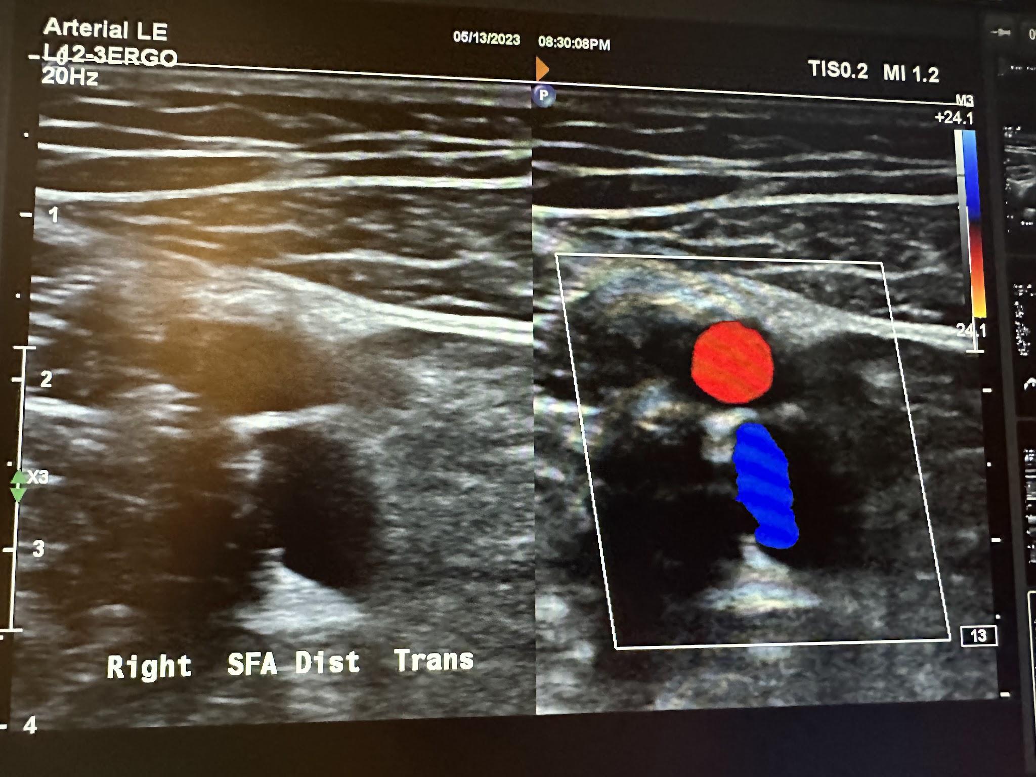 Side-by-side transverse images of the right distal superficial femoral artery without color Doppler and with color Doppler.