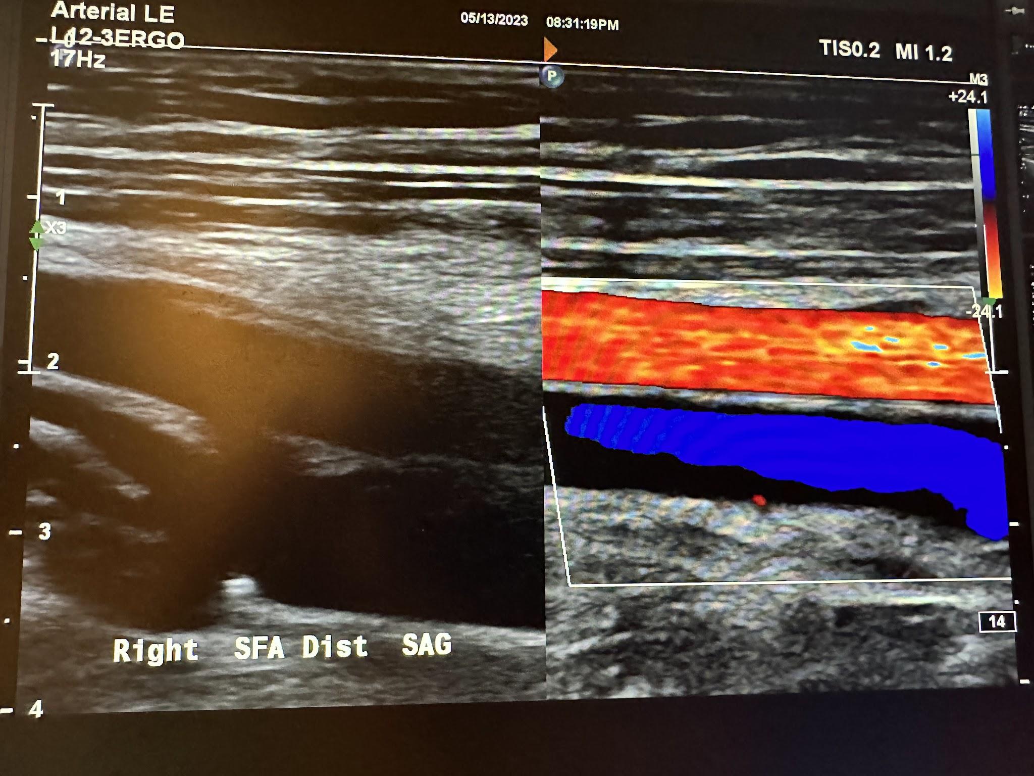 Sagittal images of the right distal superficial femoral artery without color Doppler and with color Doppler.