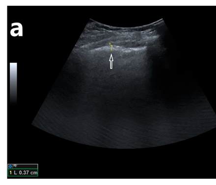 B-line artifacts arising from an apparently thickened pleural line.