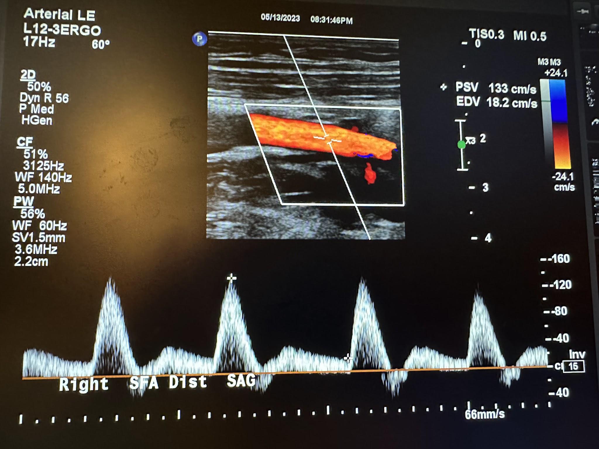 Sagittal image of the right distal superficial femoral artery with color Doppler and waveform analysis.