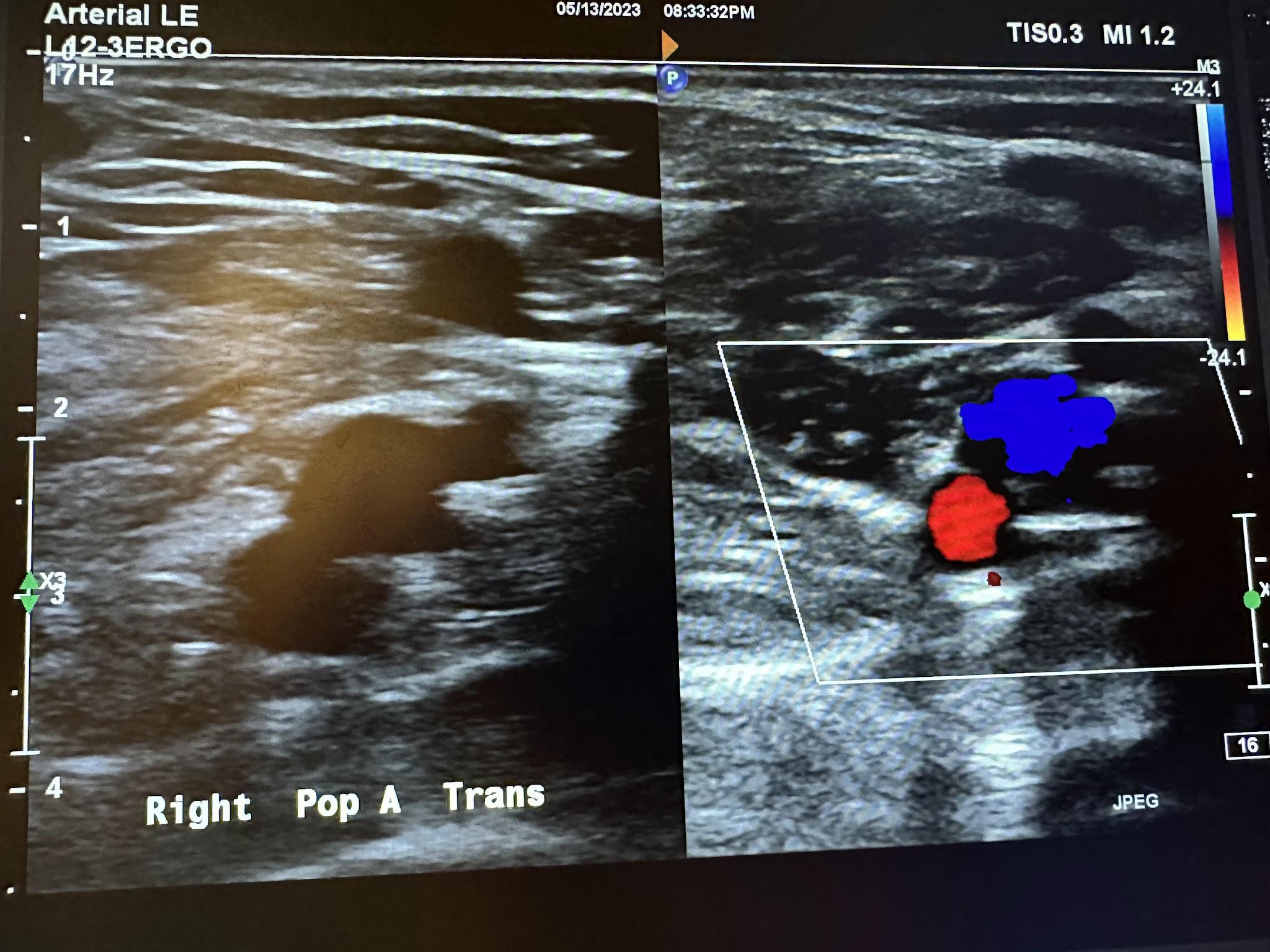 Side-by-side transverse images of the right popliteal artery without color Doppler and with color Doppler.