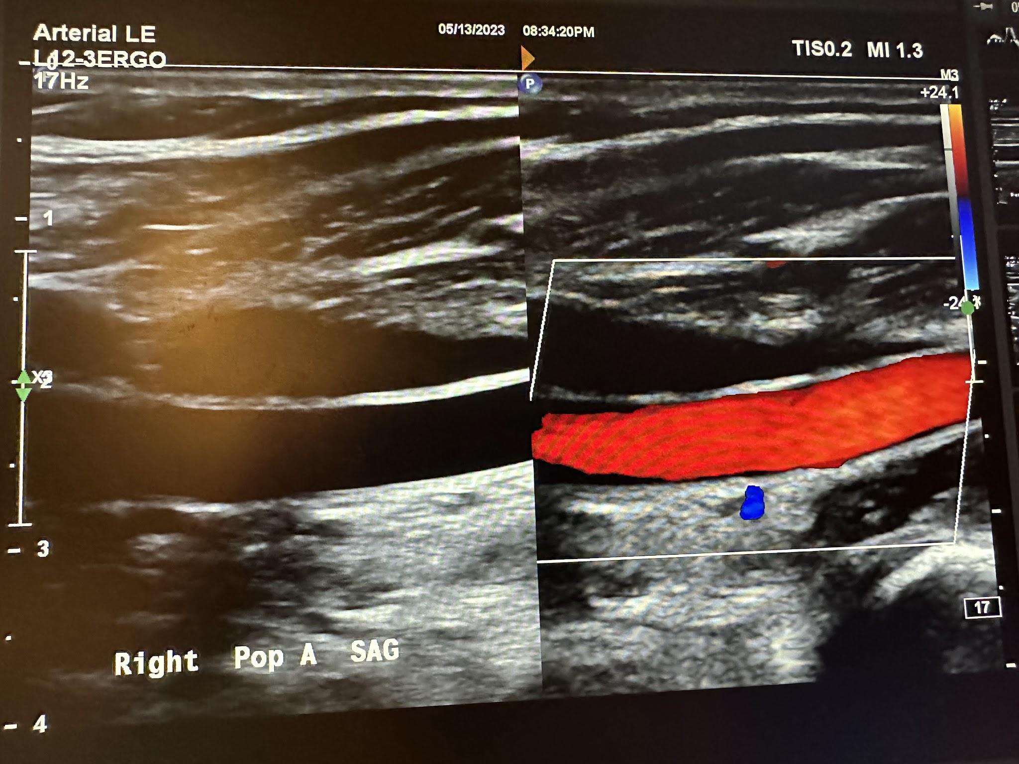 Side-by-side sagittal images of the right popliteal artery without color Doppler and with color Doppler.