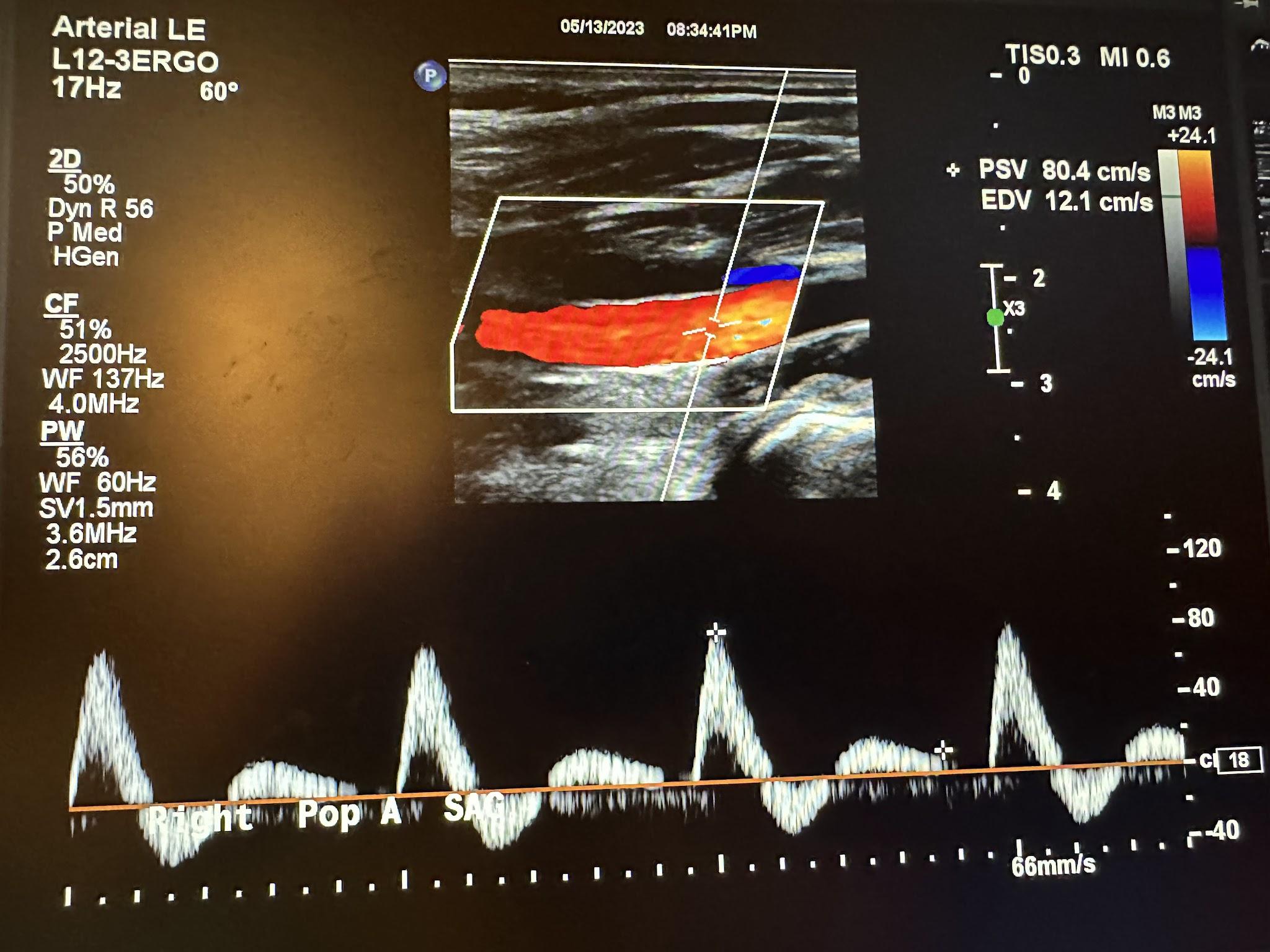 Sagittal image of the right popliteal artery with color Doppler and waveform analysis.