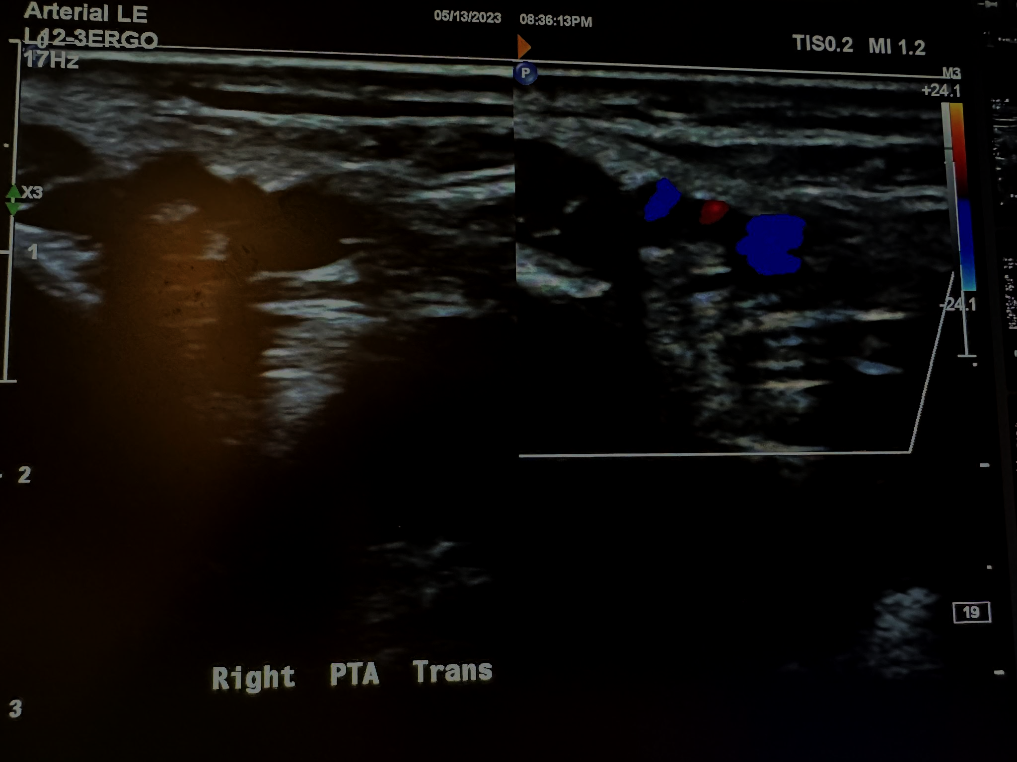 Side-by-side transverse images of the right posterior tibial artery without color Doppler and with color Doppler.