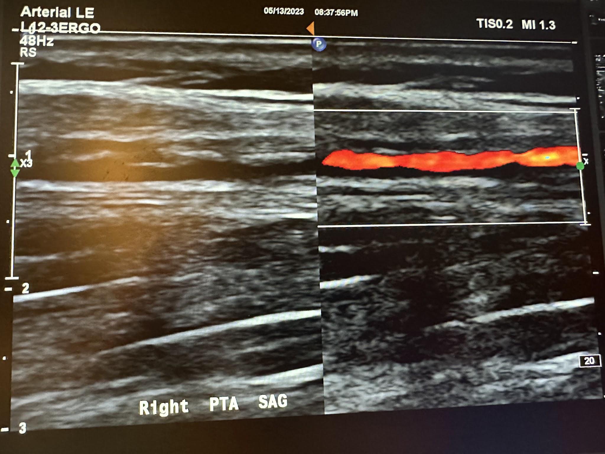 Side-by-side sagittal images of the right posterior tibial artery without color Doppler and with color Doppler.