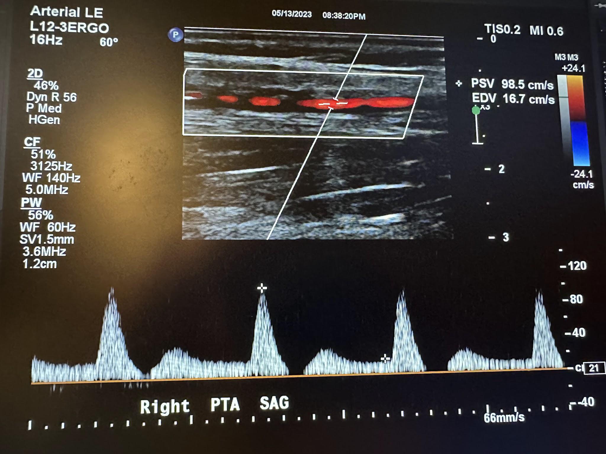 Sagittal image of the right posterior tibial artery with color Doppler and waveform analysis.