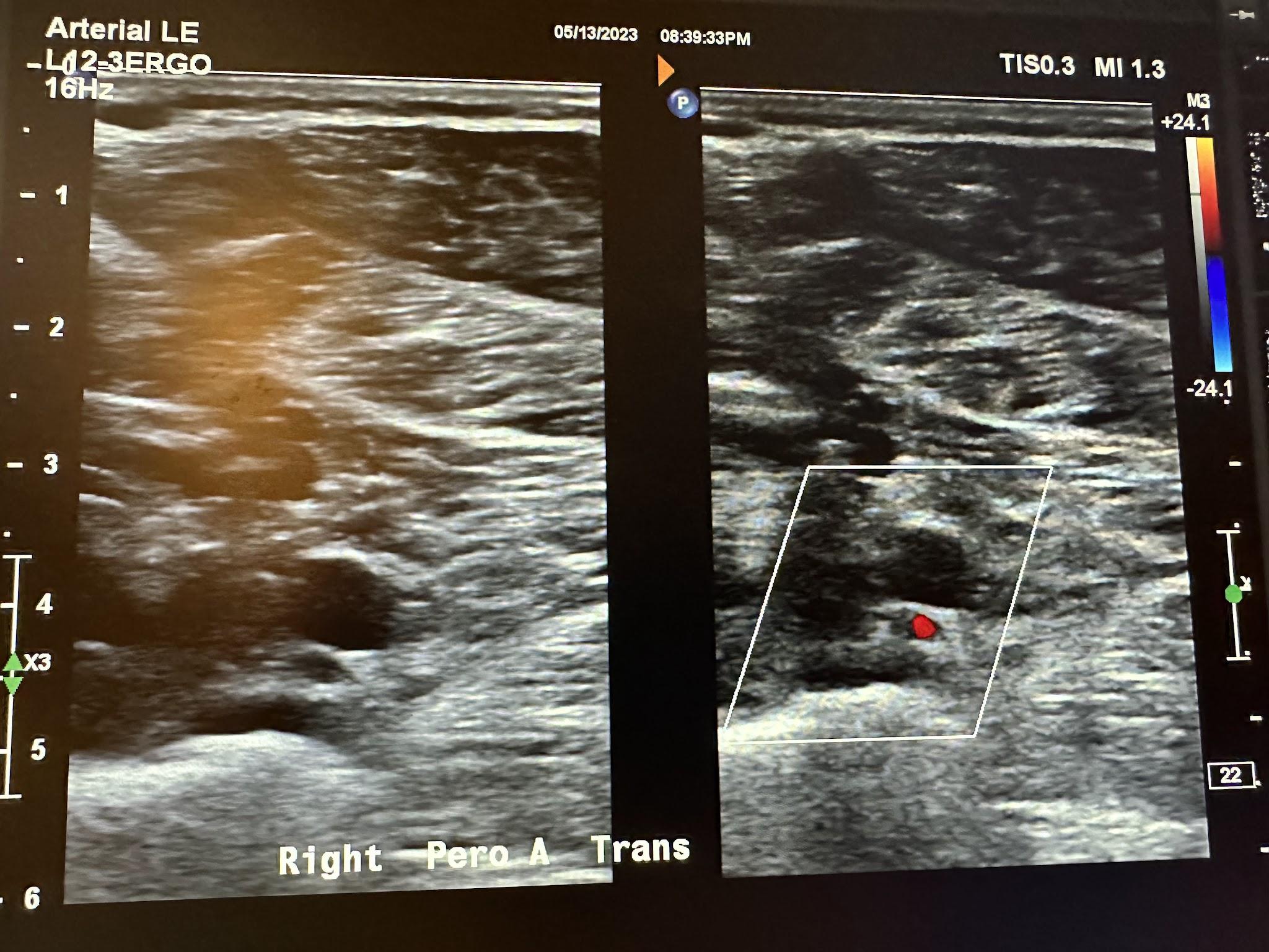 Side-by-side transverse images of the right peroneal artery without color Doppler and with color Doppler.