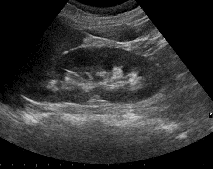 Ultrasound image of the longitudinal view of the normal left kidney.