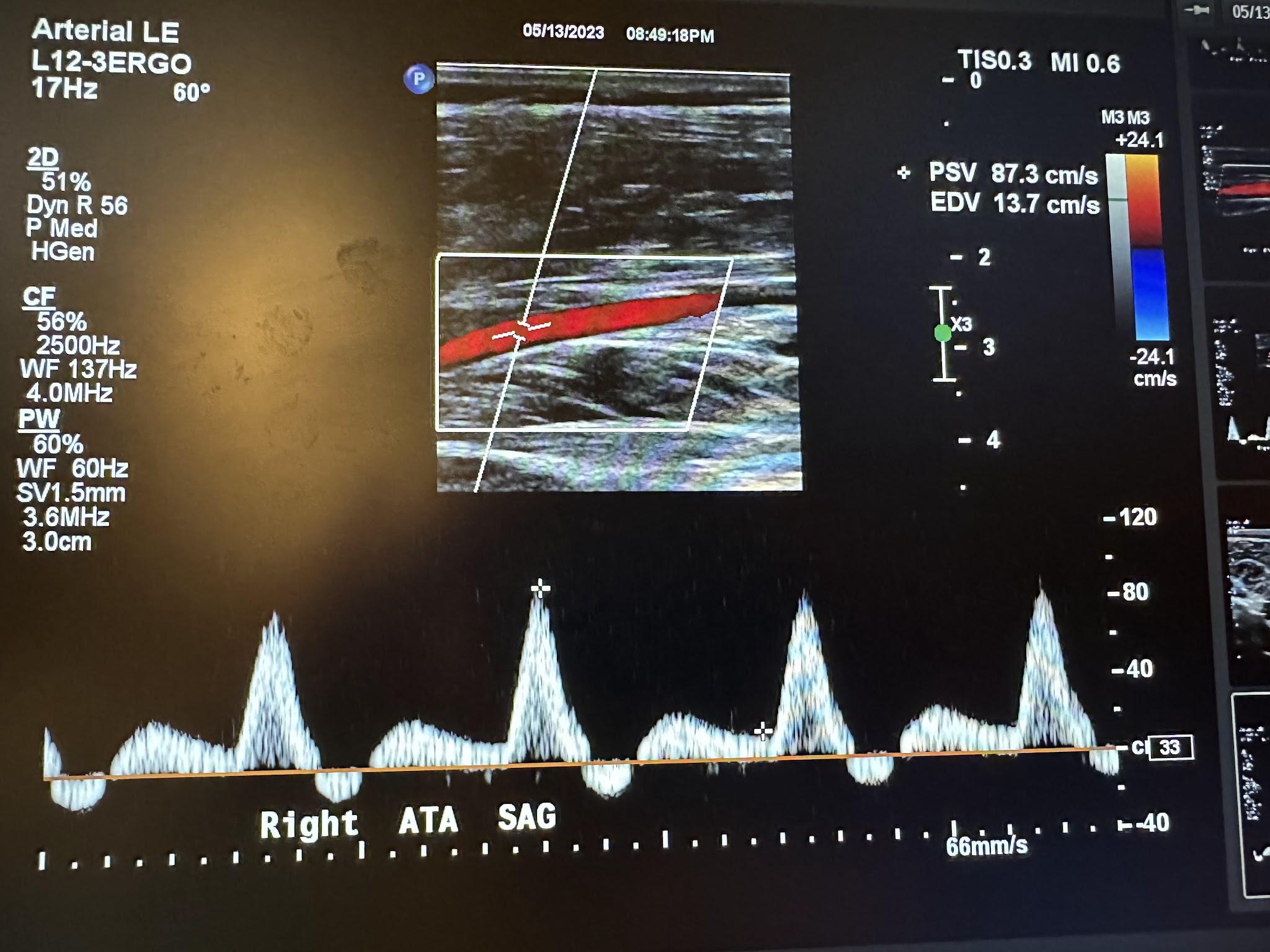 Sagittal image of the right anterior tibial artery with color Doppler and waveform analysis.