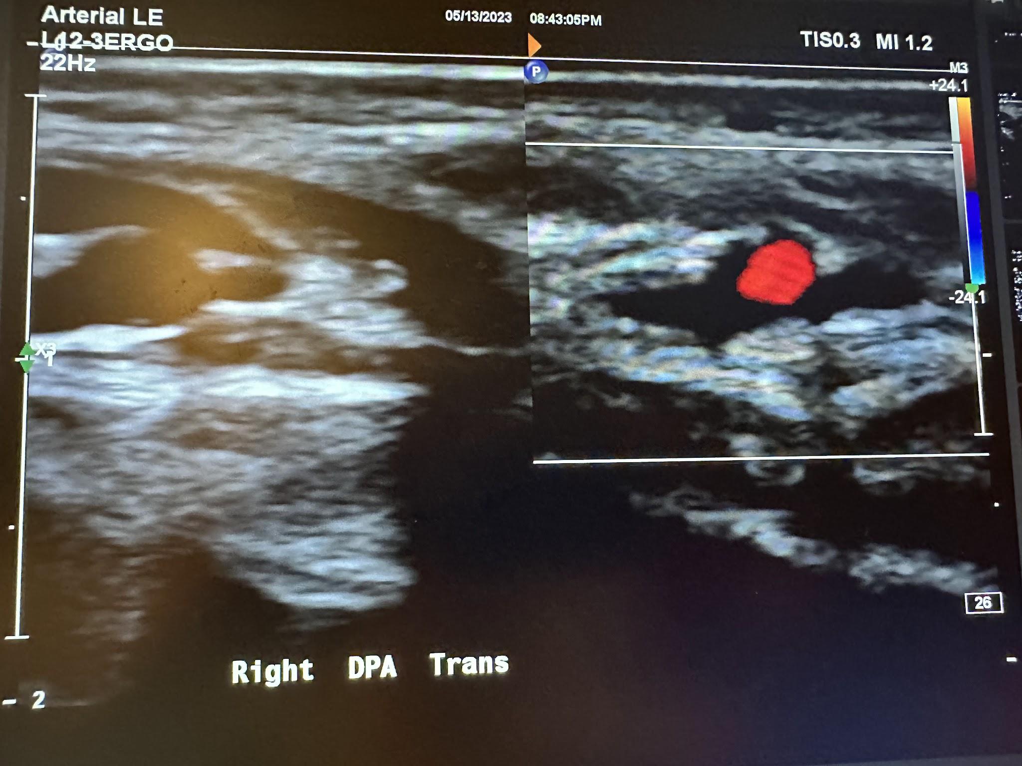 Side-by-side transverse images of the right dorsalis pedis artery without color Doppler and with color Doppler.