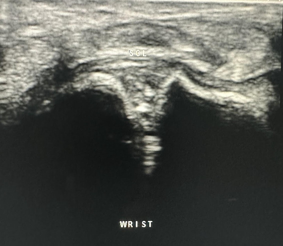 Dorsal wrist image of the scapholunate ligament (SCL).