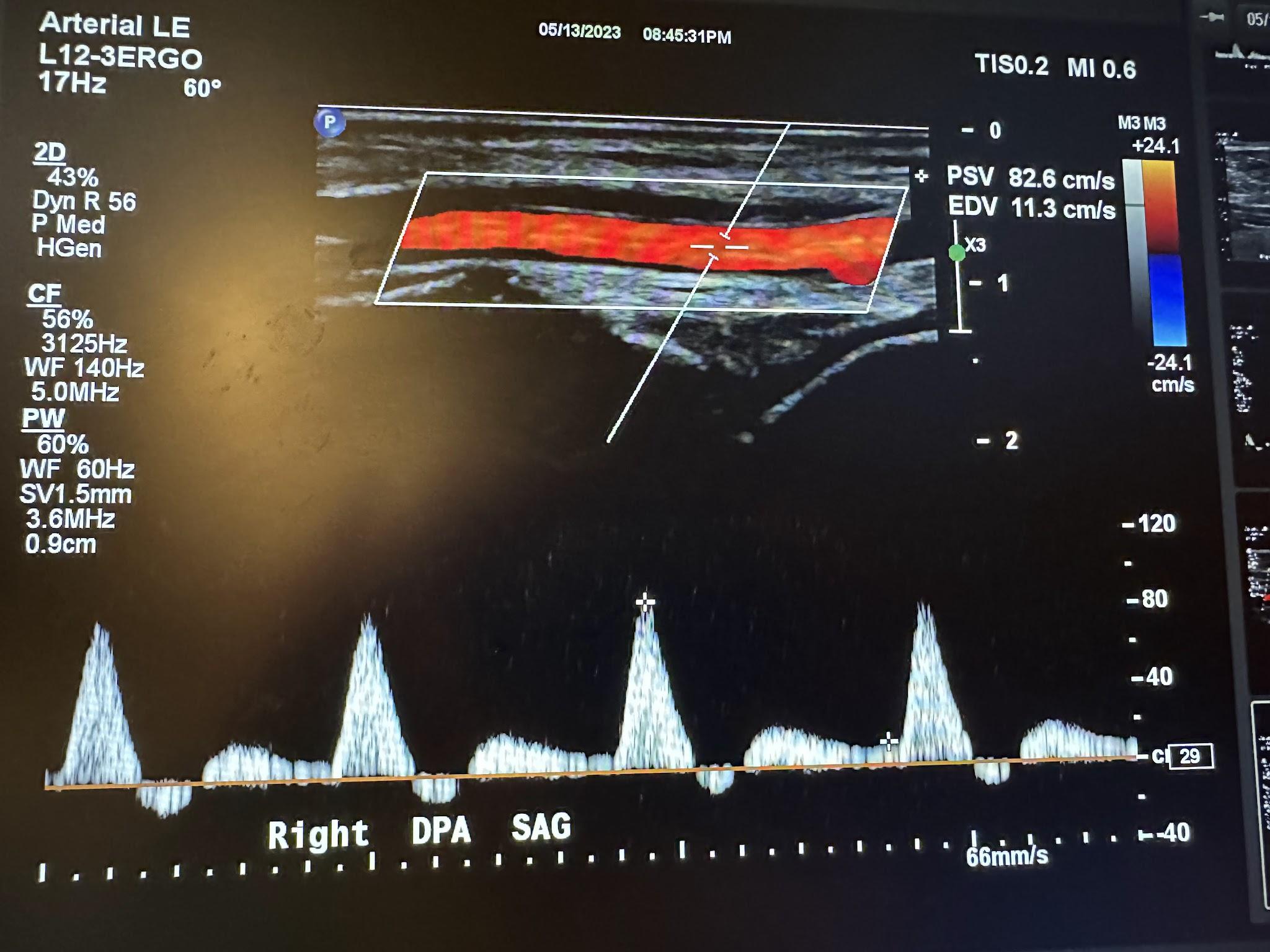 Sagittal image of the right dorsalis pedis artery with color Doppler and waveform analysis.