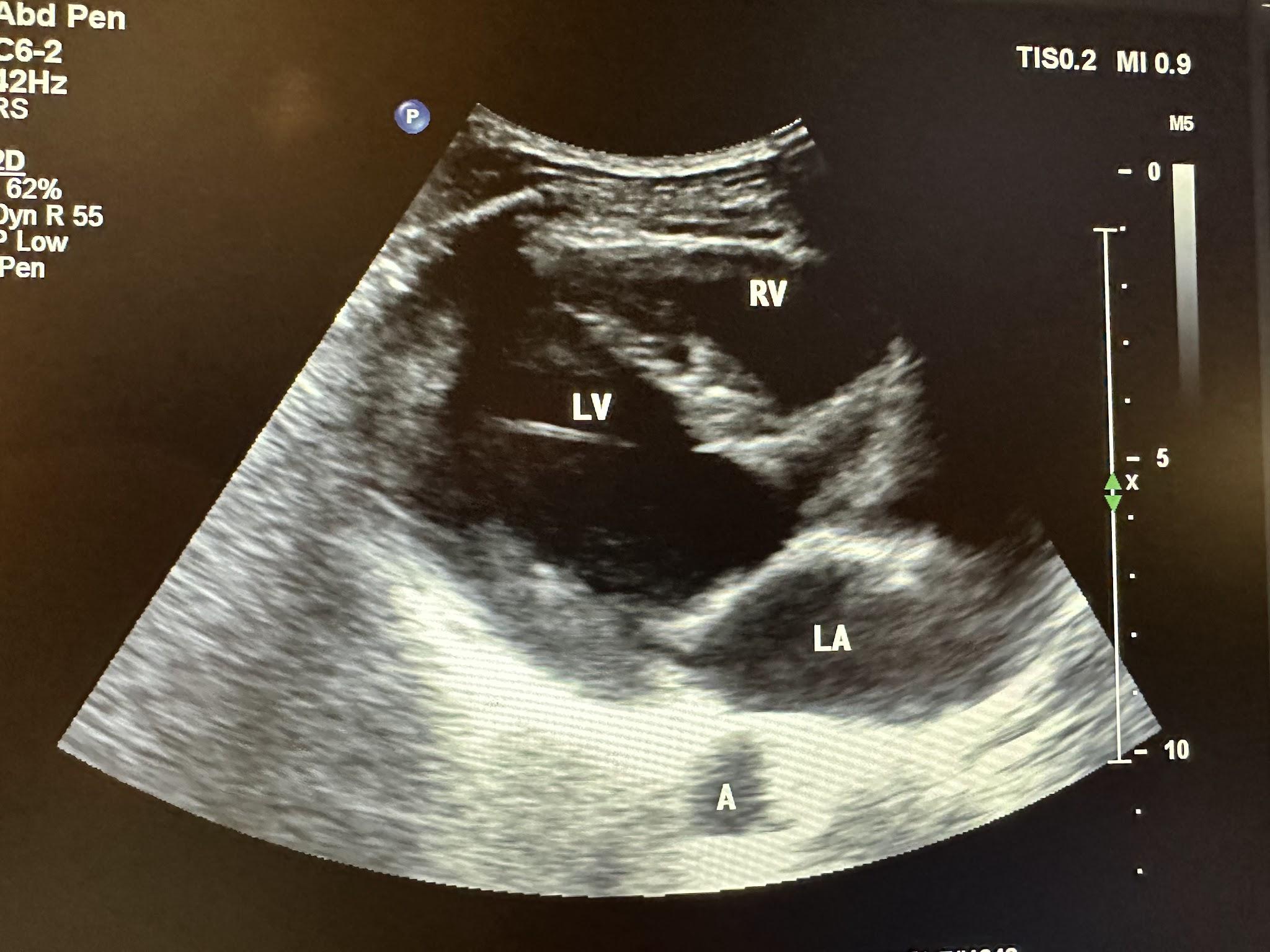 Parasternal sagittal view of the heart showing the left ventricle, right ventricle, left atrium, and aorta.