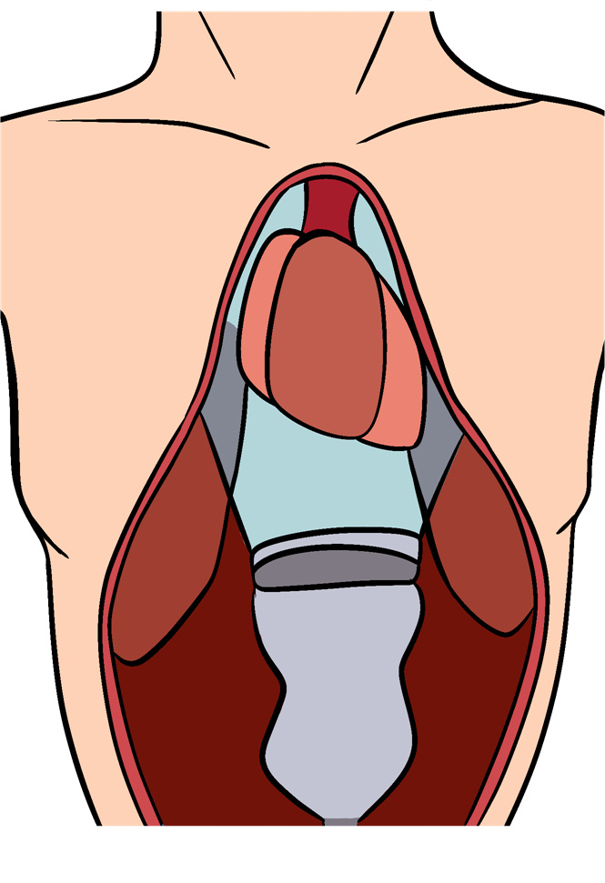 Subxiphoid view of the heart.