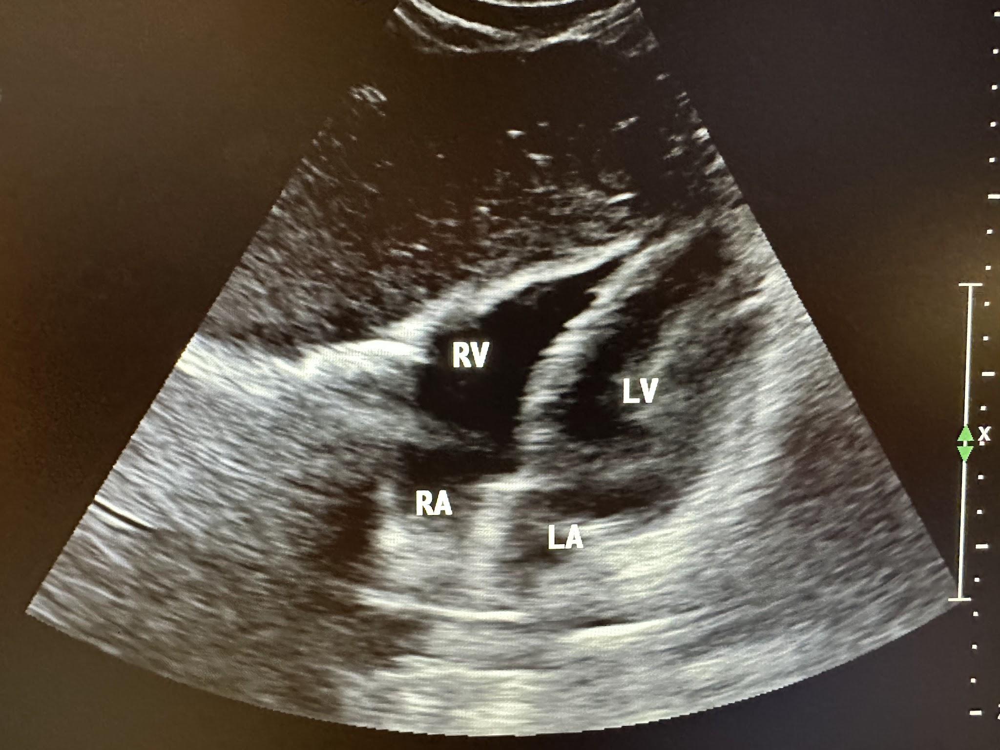 Subxiphoid four-chamber view of the heart showing the left ventricle, left atrium, right ventricle, and right atrium.