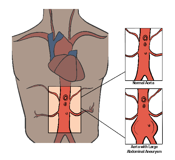 Schematic of the abdominal aorta showing that it branches into the right and left iliac arteries.