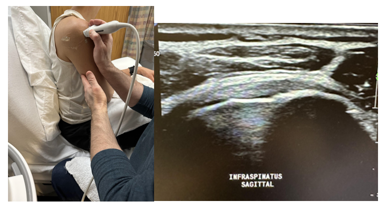 The infraspinatus in the longitudinal (sagittal) plane.