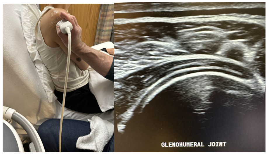 The posterior glenohumeral joint on ultrasound.