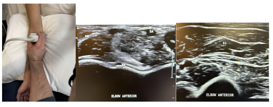 Side-by-side pictures of the transducer position on the elbow and anterior transverse elbow imaging of the anterior recess (AR), radial nerve (RN), brachial artery (BA), median nerve (MN), biceps (BI), and brachialis (BR) just proximal to the elbow crease. The abbreviations given here and labeled on the ultrasound images represent the corresponding structures.