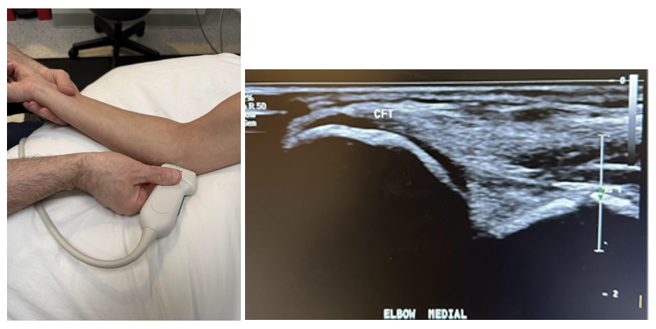 Side-by-side pictures of the transducer position and a longitudinal image of the medial elbow showing the common flexor tendon (CFT).