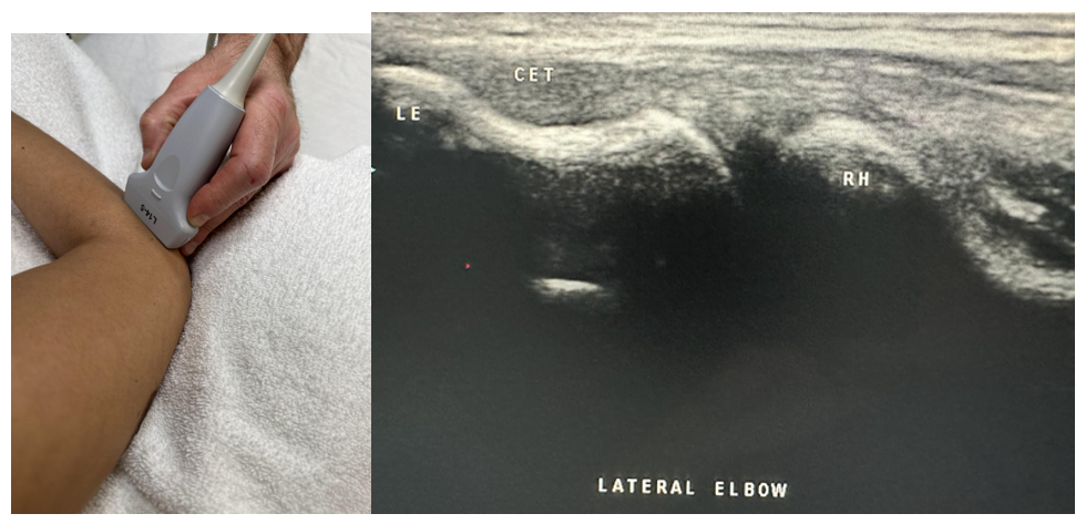 Side-by-side pictures of the transducer position and a longitudinal image of the lateral elbow showing the common extensor tendon (CET), lateral epicondyle (LE), and radial head (RH). The abbreviations given here and labeled on the ultrasound image represent the corresponding structures.