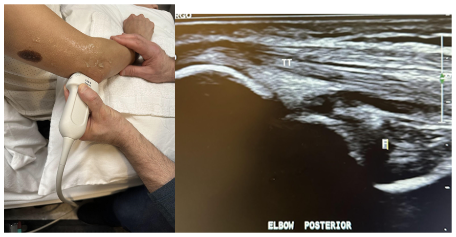 Side-by-side pictures of the transducer position and a posterior longitudinal image of the elbow showing the triceps tendon (TT) and the olecranon fossa (F). The abbreviations given here and labeled on the ultrasound image represent the corresponding structures.