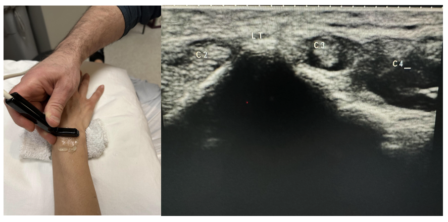 Side-by-side pictures of the transducer position and dorsal transverse wrist showing the second extensor tendon compartment (C2), Lister’s tubercle (LT), third extensor tendon compartment (C3), and fourth extensor tendon compartment (C4ETC). The abbreviations given here and labeled on the ultrasound image represent the corresponding structures.