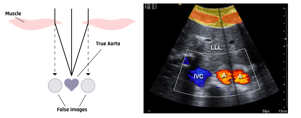 The figure on the left illustrates how a double image artifact is formed, and the one on the right is the actual double image artifact of an aorta on an ultrasound image.