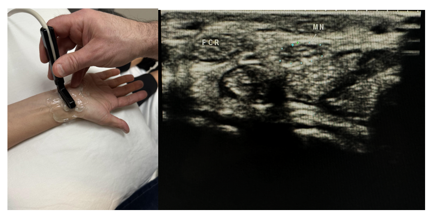 Side-by-side pictures of the transducer position and volar wrist showing the median nerve (MN) and flexor carpi radialis (FCR). The abbreviations given here and labeled on the ultrasound image represent the corresponding structures.