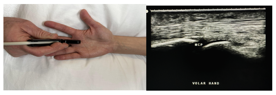 Side-by-side pictures of the transducer position and sagittal volar hand imaging of the metacarpal phalangeal joint (MCP) and the flexor tendon (FT). The abbreviations given here and labeled on the ultrasound image represent the corresponding structures.