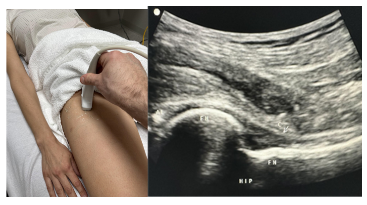 Side-by-side pictures of the transducer position and anterior hip sagittal imaging of the anterior labrum (AL), the femoral head (FH), the femoral neck (FN), and the femoral capsule (C). The abbreviations given here and labeled on the ultrasound image represent the corresponding structures.